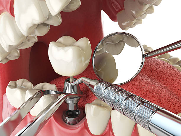 Best Emergency Dental Care for Broken or Chipped Teeth in Fort Belvoir, VA